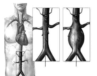 腹主動(dòng)脈瘤